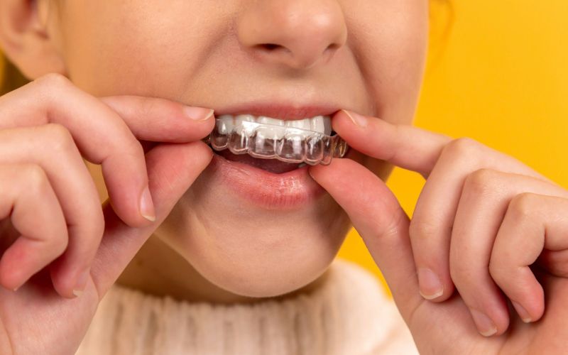 Invisalign preț 2026: cât costă în România pe variante