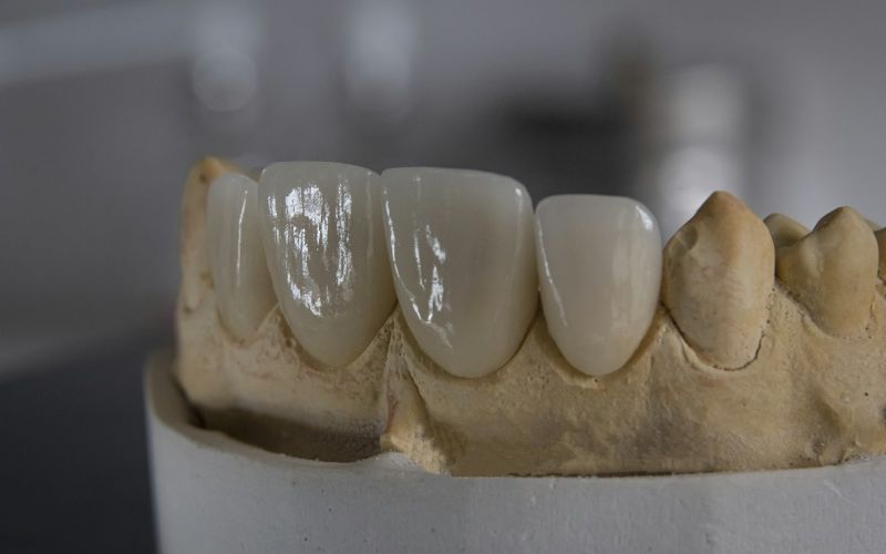 Coroane de zirconiu