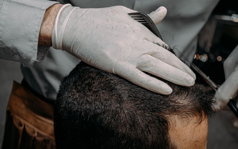Implant de păr FUE