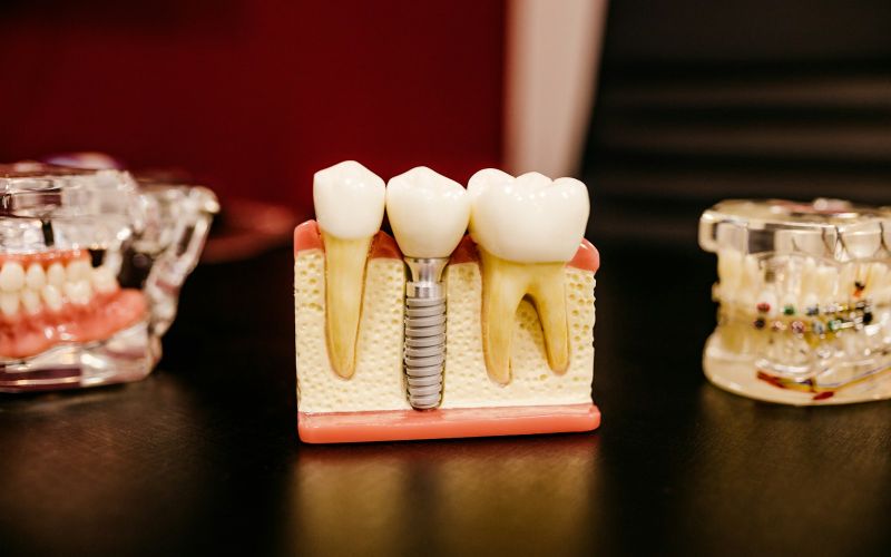 Implant dentar